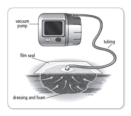 VAC Dressing at Home – MedLoc