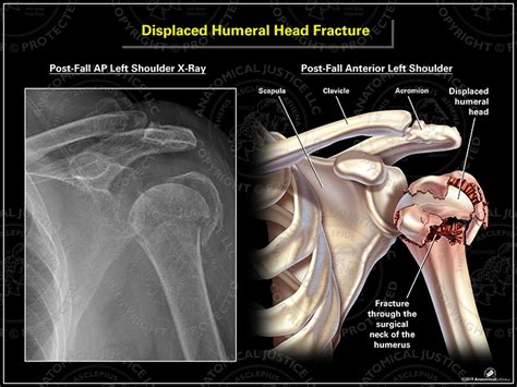 Mechanisms Of Humeral Head Fracture