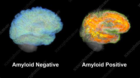 Healthy brain and brain with amyloid plaques, MRI scans - Stock Image - C058/2165 - Science ...