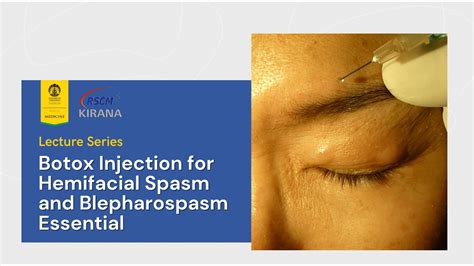 Neuro-ophthalmology Lecture: Botox Injection for Hemifacial Spasm and Blepharospasm Essential ...