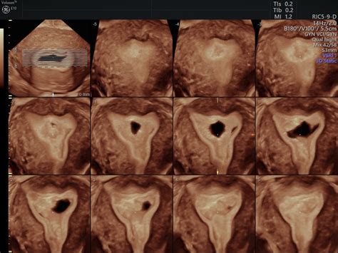 Patients Prefer Transvaginal Ultrasound Over MRI | Empowered Women's Health