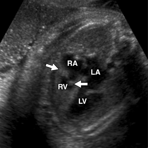 Hypoplastic right heart syndrome causes, symptoms, diagnosis, treatment & prognosis