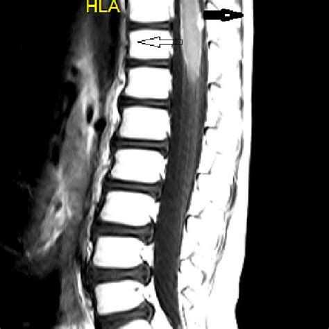 Sagittal T1-weighted post-contrast MRI of the thoracic spine... | Download Scientific Diagram