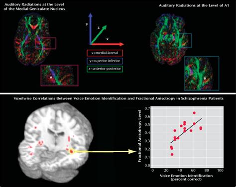 Fractional Anisotropy Map at the Level of the Medial Geniculate Nucleus... | Download Scientific ...