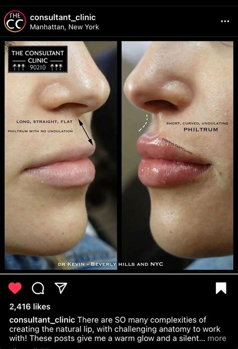 Why the lip flip procedure is quietly becoming the new go to for fuller ...