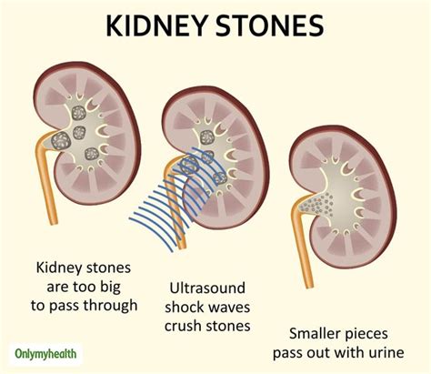 Nephrolithiasis: Dr Jyoti Sharma Shares Homeopathic Remedies To Treat Kidney Stones | OnlyMyHealth