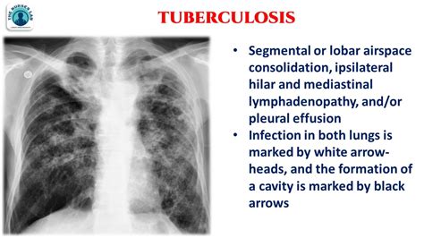 Tuberculosis Chest X Ray Findings