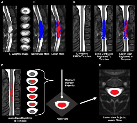 Incomplete Spinal Cord Syndromes