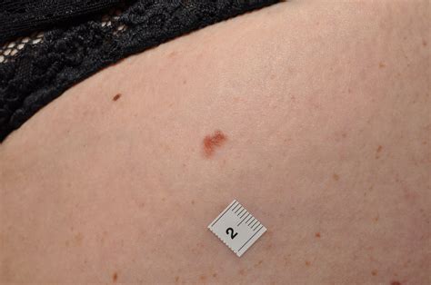 Mole Clinic and Mole Mapping - Dr Bela Clinic West London