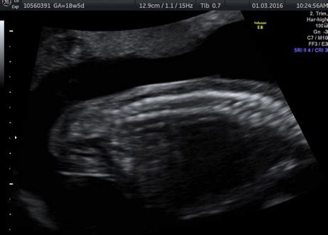 Intrauterine Blood Transfusion - Apollo Centre for Fetal Medicine