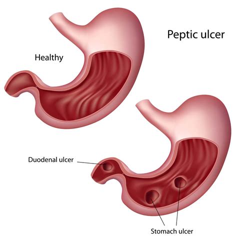 Stomach Ulcer; Gastric Ulcer