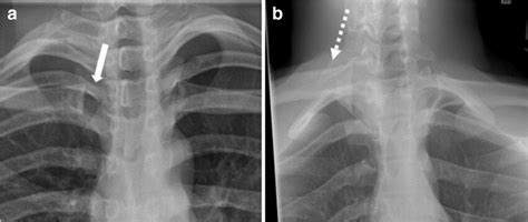 Anterior displacement of the sternoclavicular joint. a Frontal and (b ...