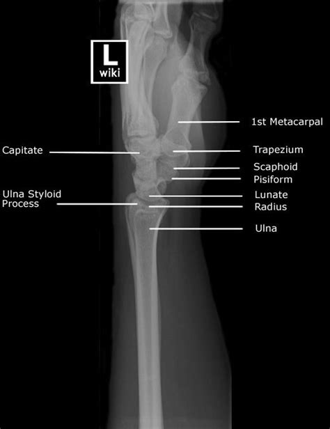 Radiographic Anatomy - Wrist Lateral | Radiology, Radiology student, Radiology technologist