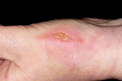 Infected Burn Photograph by Dr P. Marazzi/science Photo Library