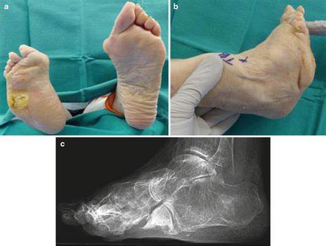 Chopart’s Amputation for Osteomyelitis of the Midfoot | Musculoskeletal Key