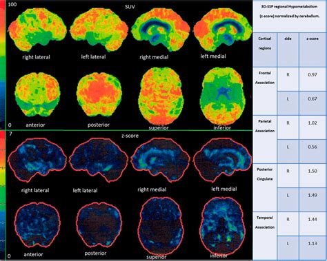 Results of the FDG-PET study in single patient generated automatically ...