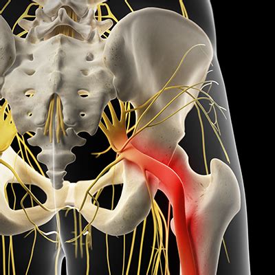 Sciatica Treatment Options, Causes and Symptoms