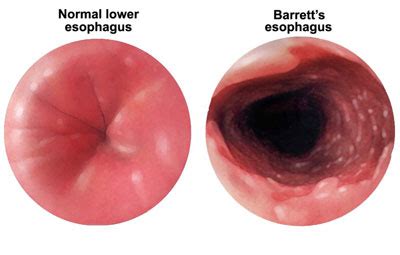 Barretts Esophagus Buffalo NY | Antonino Mannone - Main Gastroenterology