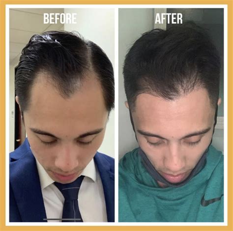 Hairline restoration - Concord Hair Restoration