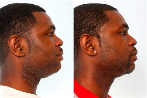 Laser Hair Removal Photos | Houston, Tx | Patient 10171