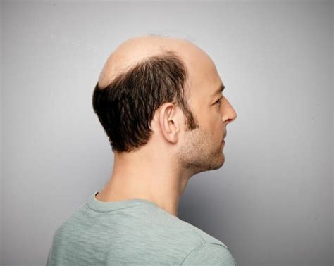 Hair Replacement Options for Men - Allusions | Cincinnati Hair Loss