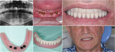 implants 2 - Green lane Dental Centre