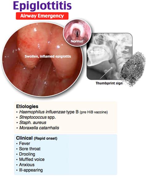 Epiglottitis A... - Anesthesia and Intensive Care Knowledge