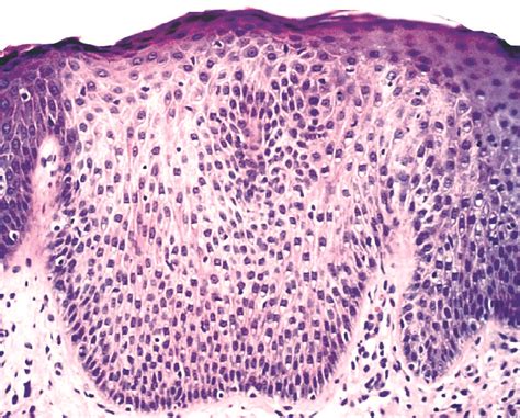 Pathology Outlines - Clear cell acanthoma