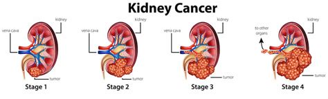 Renal cell carcinoma causes, risk factors, symptoms, prognosis & treatment