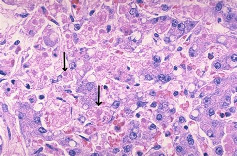 Hepatic Pathology