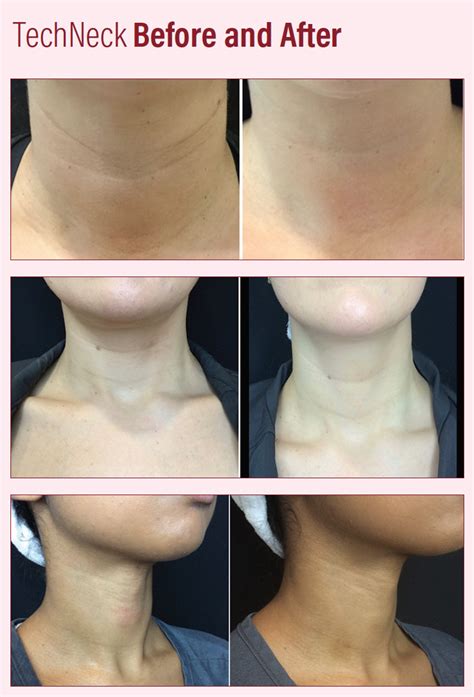 Now Trending: #TechNeck - Practical Dermatology