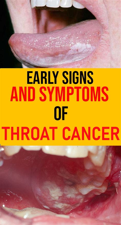 Throat Cancer: Early Signs, Symptoms, Causes, and Prognosis - Healthy Lifestyle