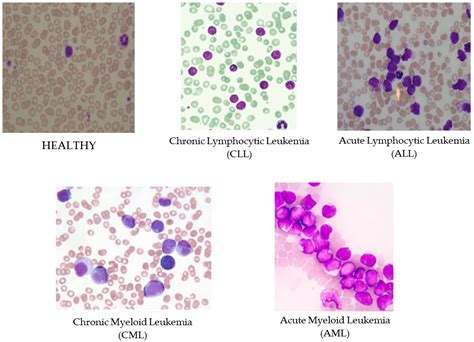 Diagnostics | Free Full-Text | Identification of Leukemia Subtypes from ...