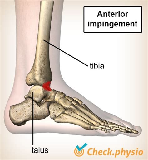 Anterior ankle impingement | Physio Check