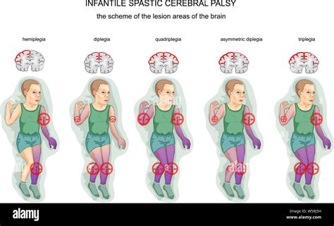 Paralysie infantile Banque d'images détourées - Alamy