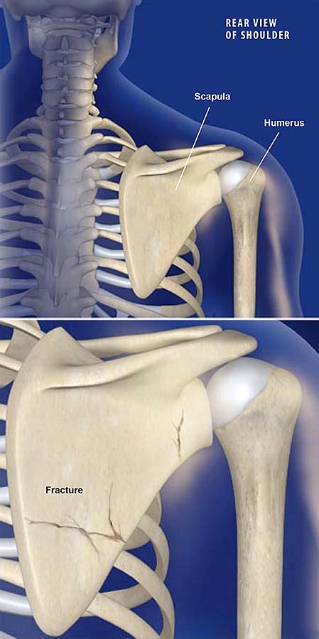 Fractures of the Shoulder Blade (Scapula) | Central Coast Orthopedic ...