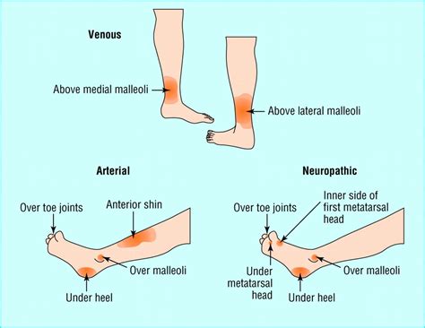 Types and typical sites of leg ulcer | Wound care nursing, Medical ...