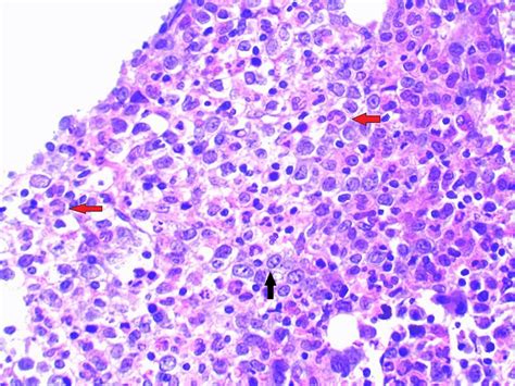 Bone marrow trephine biopsy showing megaloblastic erythropoiesis ...