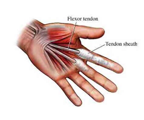 Tendon Injuries / Repair - South Florida Hand Surgery