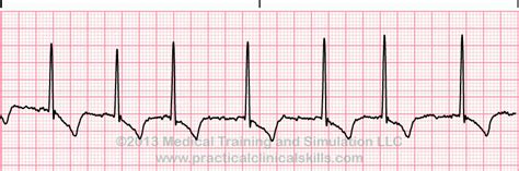 Atrial Rhythms ECG Interpretation