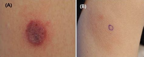 Clinical manifestation of the skin lesions. (A) A tende | Open-i