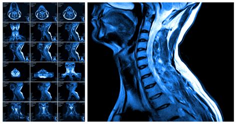 Section Spotlight: Neuroradiology 3 - TRA Endovascular