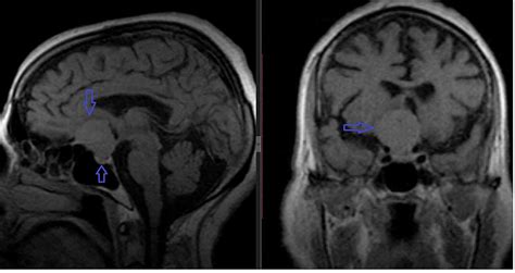 Cureus | Suprasellar Meningiomas: An Experience of Four Cases With ...