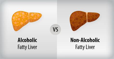 Alcoholic Vs Non-Alcoholic Fatty Liver Disease