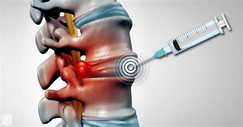 Epidurals | Interventional Pain Management Center