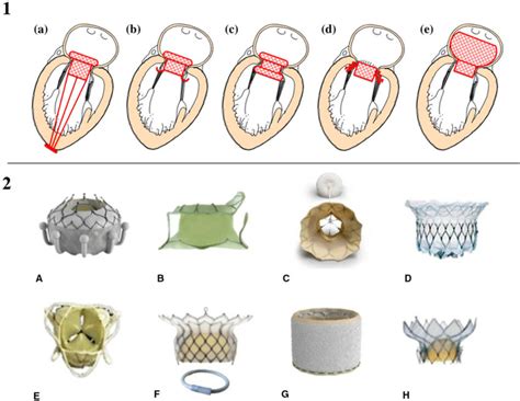 (1) Percutaneous mitral valve anchoring systems: (a) Atrial flange and... | Download Scientific ...