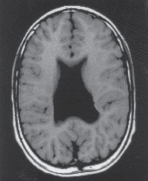 Holoprosencephaly