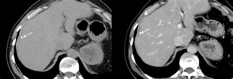 Hepatic granuloma-a peripheral calcification (arrows) in a patient with... | Download Scientific ...