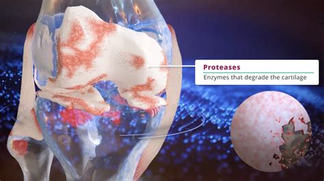 Knee Cartilage Regeneration - case study - Nanobotmedical