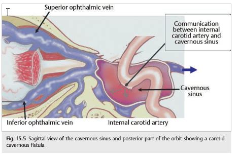 Neuro-ophthalmology questions of the week: NOI15-Cavernous Sinus and ...